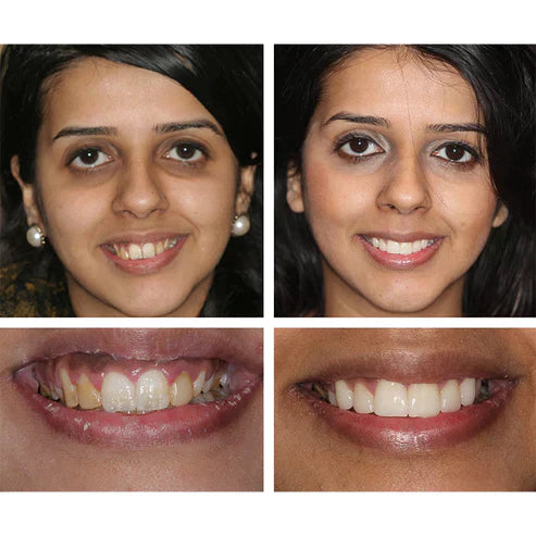 PureSmile™ Organic Teeth Whitening
