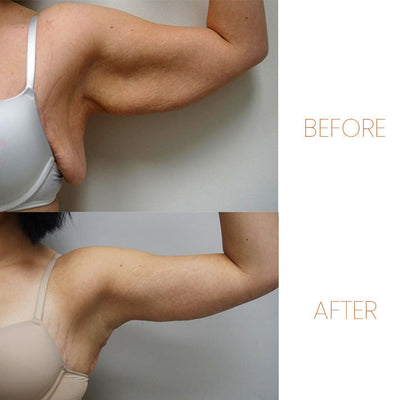 1+1 Gratis | RingTherapy™